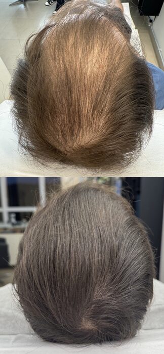 Evolução da calvície androgenética avançada