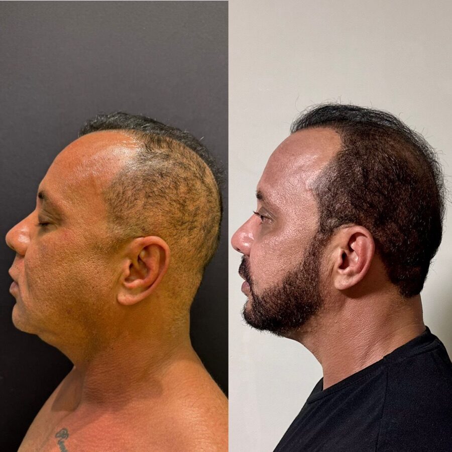 Resultado antes e depois — perfil lateral