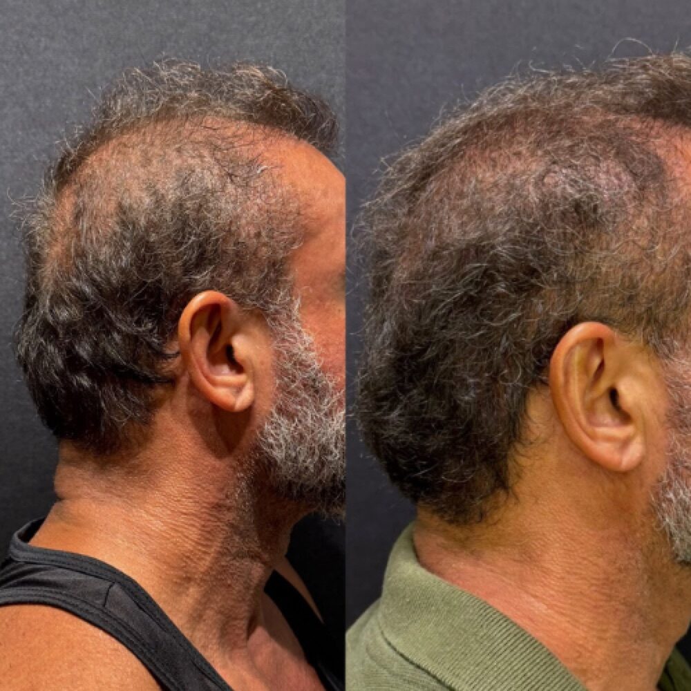 Resultado masculino · antes