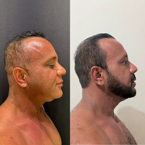 Resultado masculino · depois